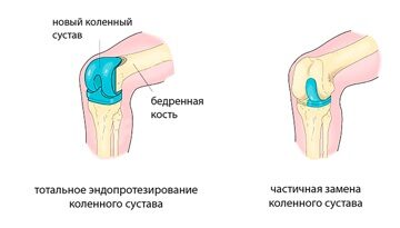 виды эндопротезирования колена